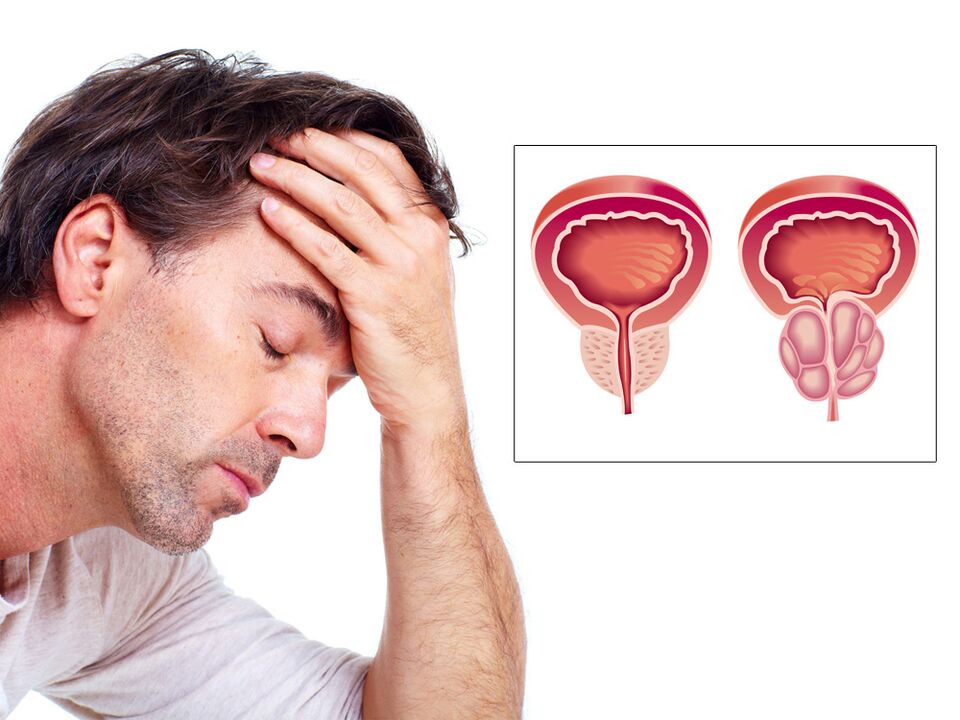 adenom prostaty s impotencí